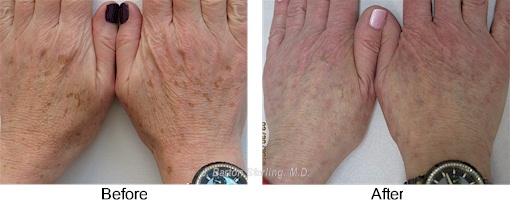 Hand Rejuvenation