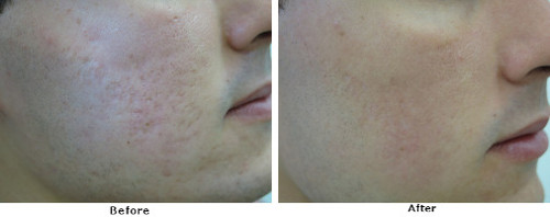 Acne scars before and after2