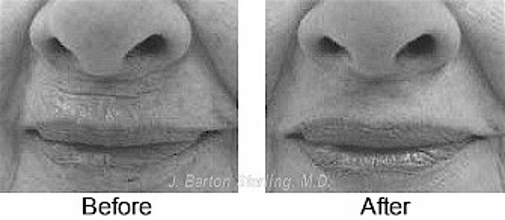 Fillers image before after3