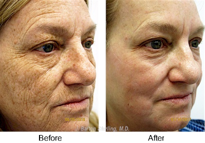 Skin Rejuvenation 21