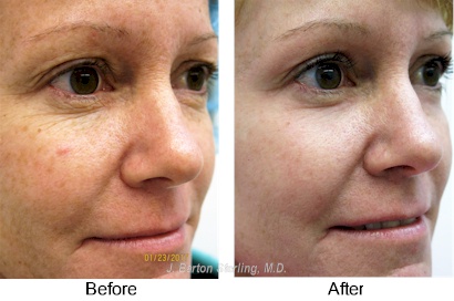 Full face peel