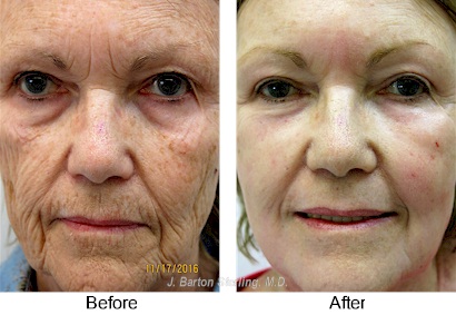 Skin Rejuvenation25