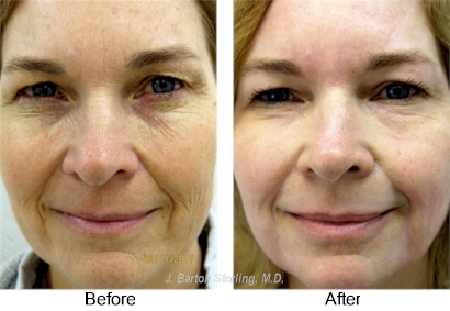 Full face chemical peel26