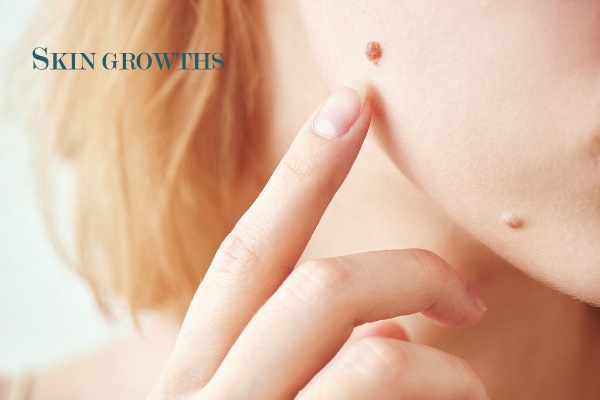 Skin growths