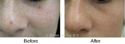 Laser treatment of red spots