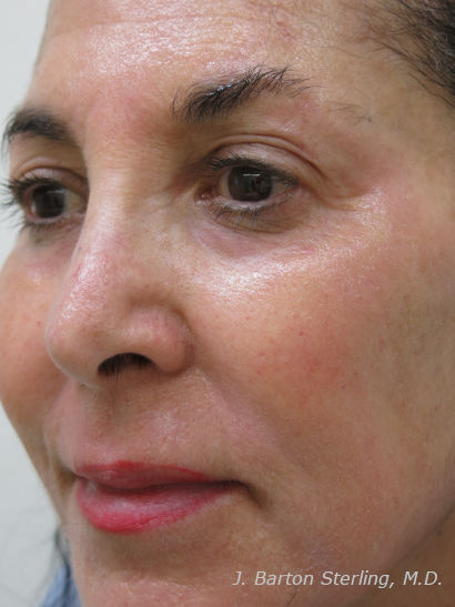 Chemical Peel52_after