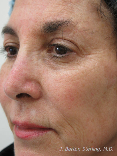 Chemical Peel52_before