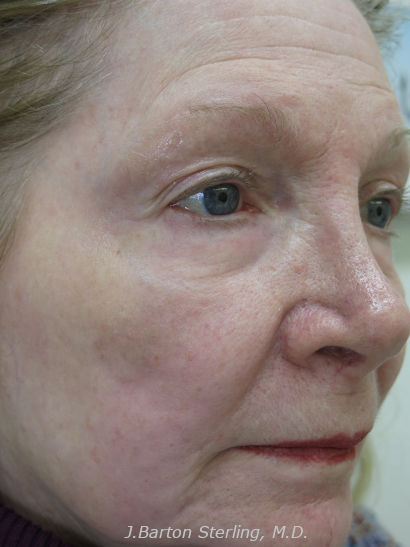 Chemical Peel53_after