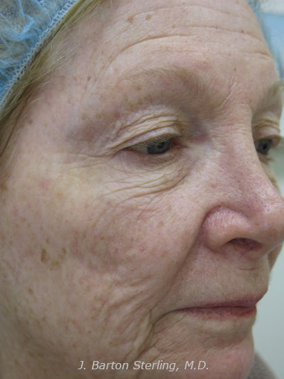 Chemical Peel53_before