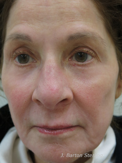 Chemical Peel54_after