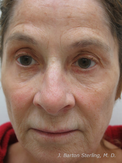 Chemical Peel54_before