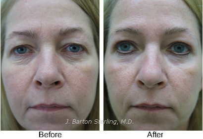 Deeper chemical peel to eyelids and frown lines between eyebrows