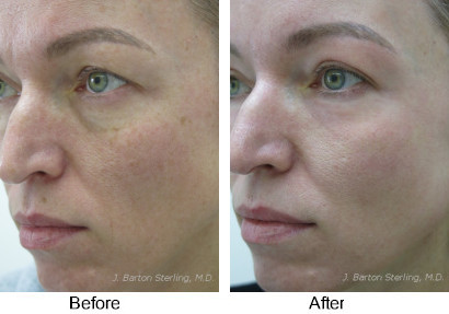 Full face chemical peel with deeper peel to the upper eyelids to tighten upper eyelid skin–a “Blepharopeel”