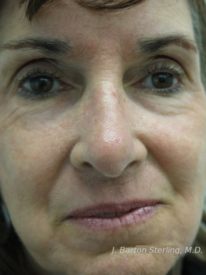 Chemical peel59_after