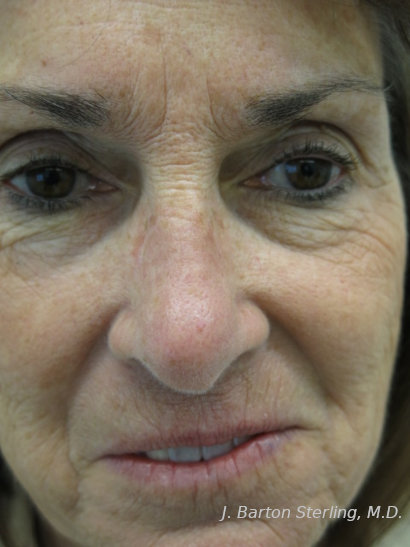 Chemical Peel59_before