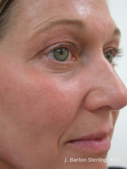 Chemical Peel60_after