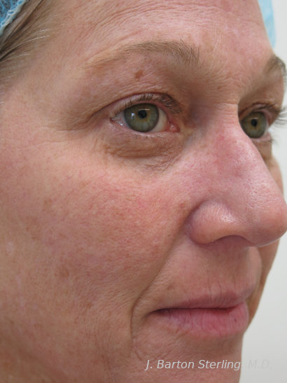 Chemical Peel60_before