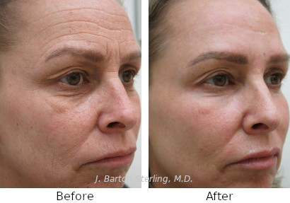 Chemical Peel 61