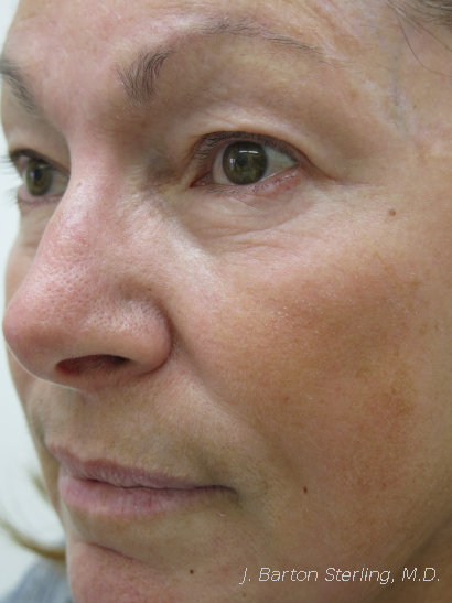 Chemical peel before side view - J. Barton Sterling, M.D.
