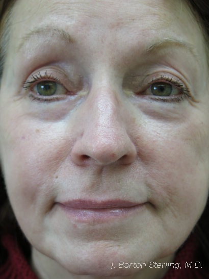 Chemical Peel64 after