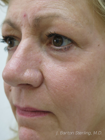 Chemical Peel73 After