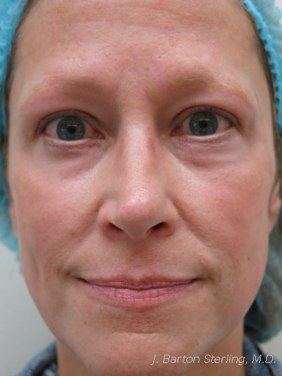 Chemical peel after - J. Barton Sterling, M.D.