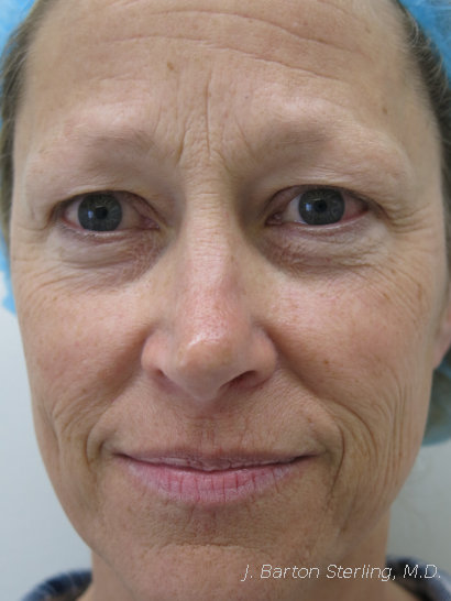 Chemical peel 74 before - J. Barton Sterling, M.D.