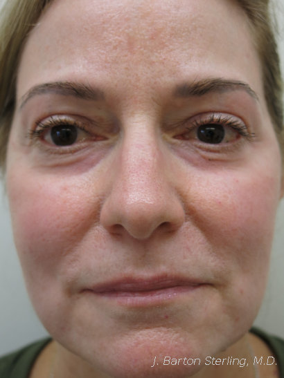 Chemical peel After - J. Barton Sterling, M.D.
