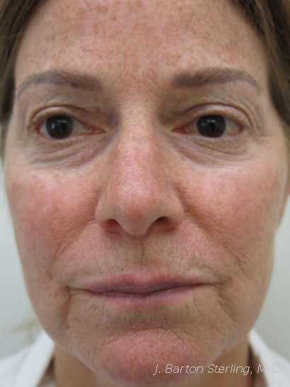 Chemical peel Before - J. Barton Sterling, M.D.