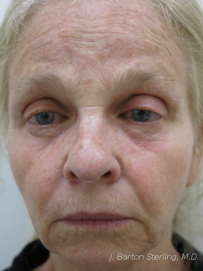 Chemical Peel 76 Before Frontal View