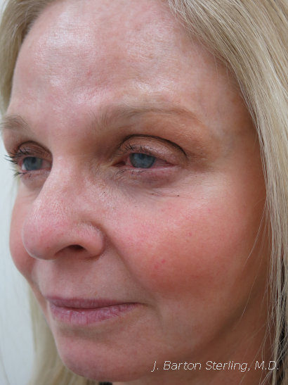 Chemical Peel 77 After Side View