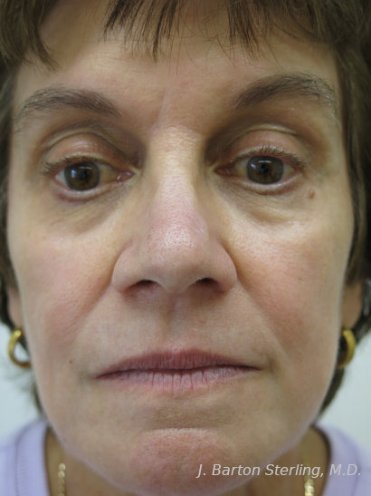 Chemical Peel84 - After