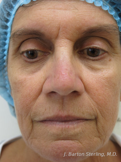 Chemical Peel84 - Before