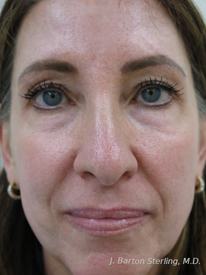 Chemical Peel86 After