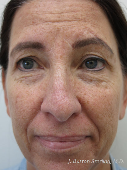 Chemical Peel86 Before