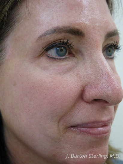 Chemical Peel87 After