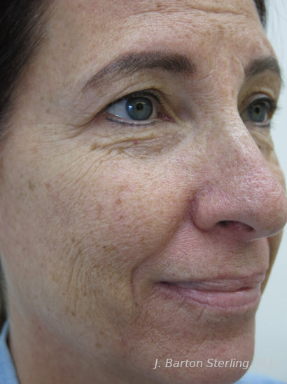 Chemical Peel87 Before