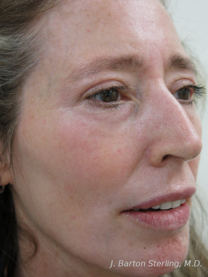 Chemical Peel88 After