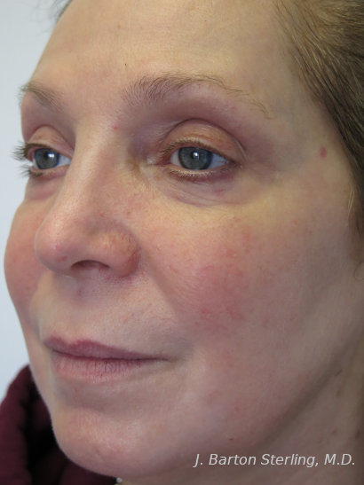Chemical Peel89 After