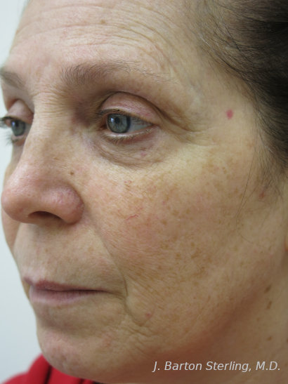 Chemical Peel89 Before