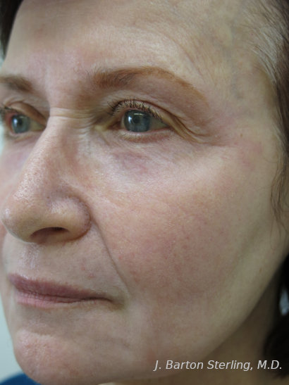 Chemical Peel 91 After