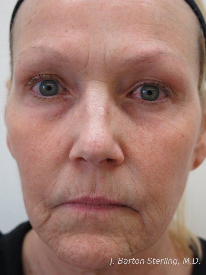 Chemical Peel 92 Before