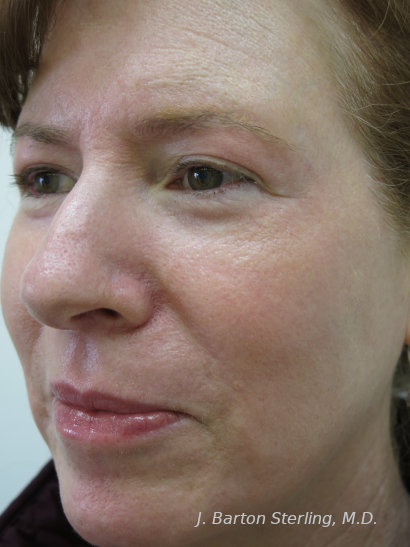 Chemical Peel 2023 2 After