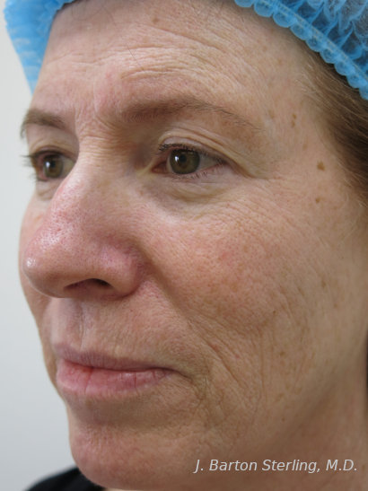 Chemical Peel 2023 2 Before