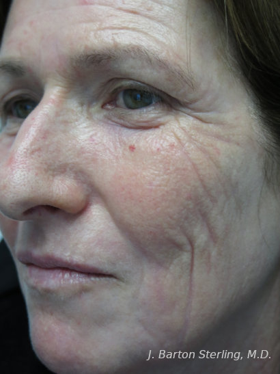Chemical Peel 2023 3 After