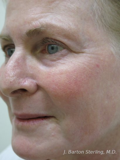 Chemical Peel 2023 4 After