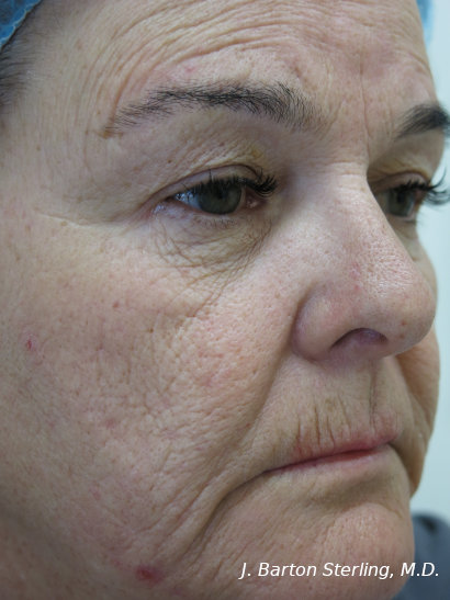 Deep Chemical Peel 101 before