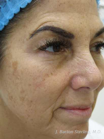 Chemical Peel102 Before