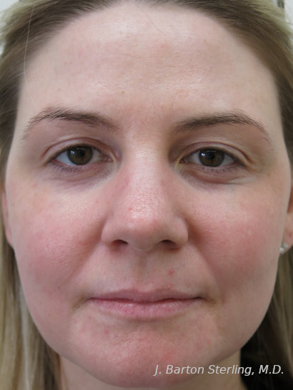 Chemical Peel 105 After