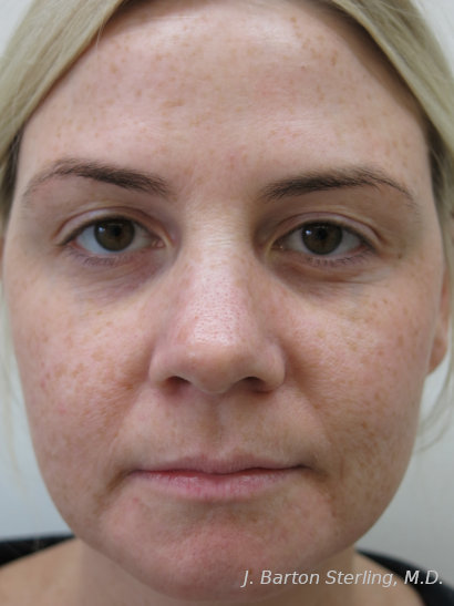 Chemical Peel 105 Before